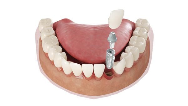 Dental Implants in US